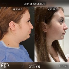 before-after photo liposuction-of-the-second-chin
