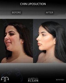 before-after photo liposuction-of-the-second-chin