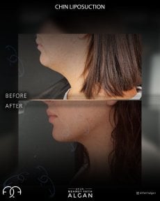 before-after photo liposuction-of-the-second-chin