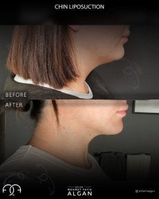 before-after photo liposuction-of-the-second-chin
