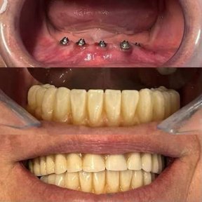 before-after photo all-on-6-dental-implants