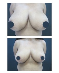 before-after photo breast-augmentation