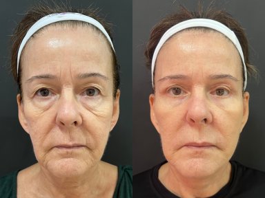 before-after photo deep-plane-facelift