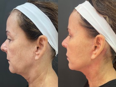 before-after photo deep-plane-facelift