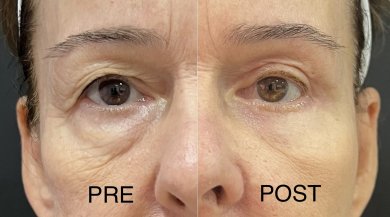 before-after photo deep-plane-facelift
