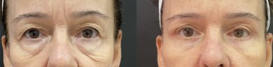 before-after photo deep-plane-facelift