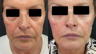before-after photo deep-plane-facelift