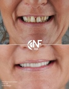 before-after photo all-on-4-dental-implants