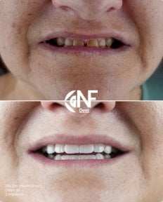 before-after photo all-on-4-dental-implants