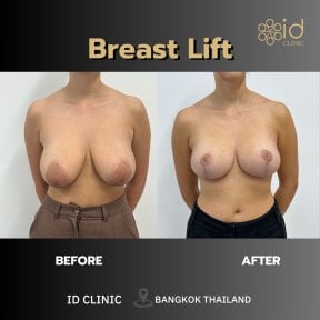 before-after photo abdominoplasty