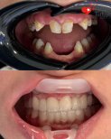 Before and after dental implant results at Health Turkiye clinic – restored smile transformation