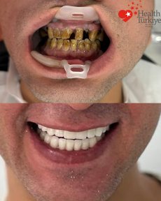Before and after dental implant results at Health Turkiye clinic – restored white smile