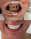 Before and after dental implant results at Health Turkiye clinic – restored white smile