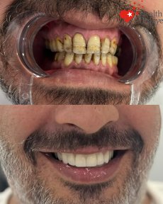 Before and after dental implant results at Health Turkey, improved smile and whiter teeth