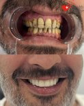 Before and after dental implant results at Health Turkey, improved smile and whiter teeth