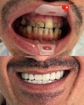 Before and after dental implant results at Health Turkiye – restored smile transformation