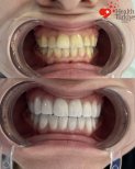 Before and after dental veneers at Health Turkiye clinic – visible smile transformation result