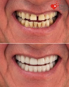Before and after dental implant results at Health Turkiye – restored smile and whiter teeth