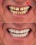 Before and after dental implant results at Health Turkiye – restored smile and whiter teeth