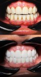 Before and after dental implant results – improved smile and whiter teeth transformation