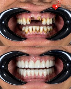 Before and after dental implant results at Health Türkiye clinic – full smile restoration