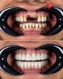 Before and after dental implant results at Health Türkiye clinic – full smile restoration