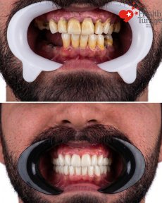 Before and after dental implant results at Health Turkey clinic – restored smile transformation