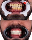 Before and after dental implant results at Health Turkey clinic – restored smile transformation