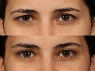 Before and after brow lift results at Dr. Alexandro Aguilera - Plastic Surgery, lifted brow area