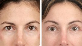 Before and after brow lift results at Dr. Alexandro Aguilera - Plastic Surgery, rejuvenated look