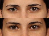 Before and after brow lift results at Dr. Alexandro Aguilera - Plastic Surgery, eye area rejuvenation