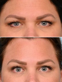 Before and after brow lift results at Dr. Alexandro Aguilera - Plastic Surgery, lifted brows