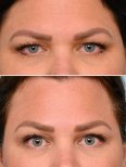 Before and after brow lift results at Dr. Alexandro Aguilera - Plastic Surgery, lifted brows