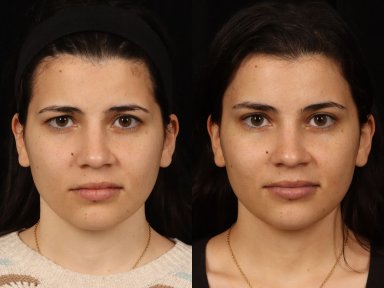 Before and after brow lift results at Dr. Alexandro Aguilera - Plastic Surgery, youthful look