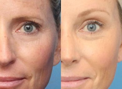 Before and after brow lift results at Dr. Alexandro Aguilera - Plastic Surgery, smoother forehead