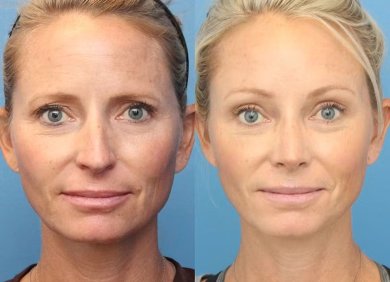 Before and after brow lift results at Dr. Alexandro Aguilera - Plastic Surgery, rejuvenated look