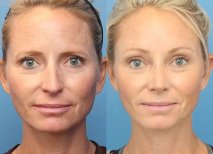 Before and after brow lift results at Dr. Alexandro Aguilera - Plastic Surgery, rejuvenated look