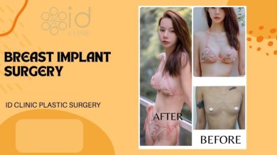 before-after photo breast-augmentation
