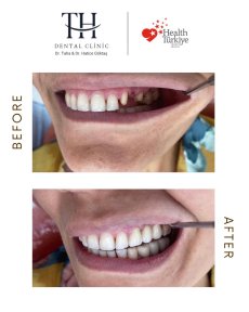 before-after photo all-on-4-dental-implants