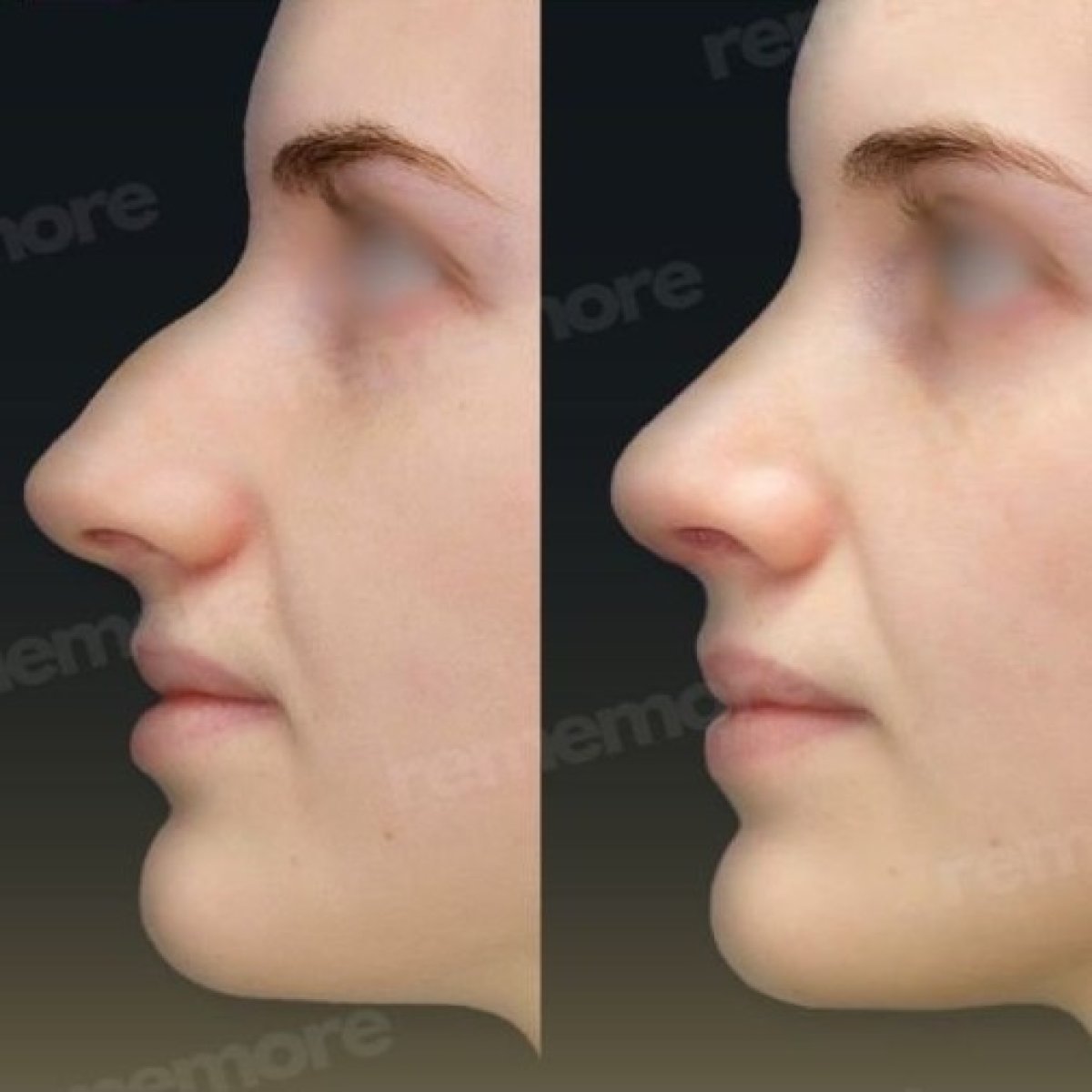 Resultados de rinoplastia antes y después en Memorial Bahçelievler Hospital, remodelación nasal