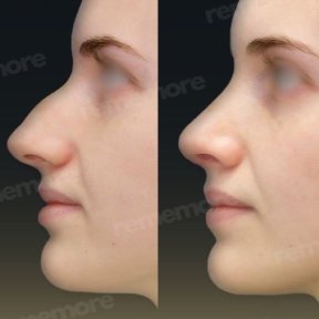 Before and after rhinoplasty results at Memorial Bahçelievler Hospital, nose reshaping outcome