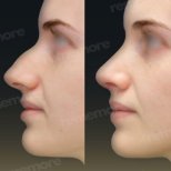 Before and after rhinoplasty results at Memorial Bahçelievler Hospital, nose reshaping outcome