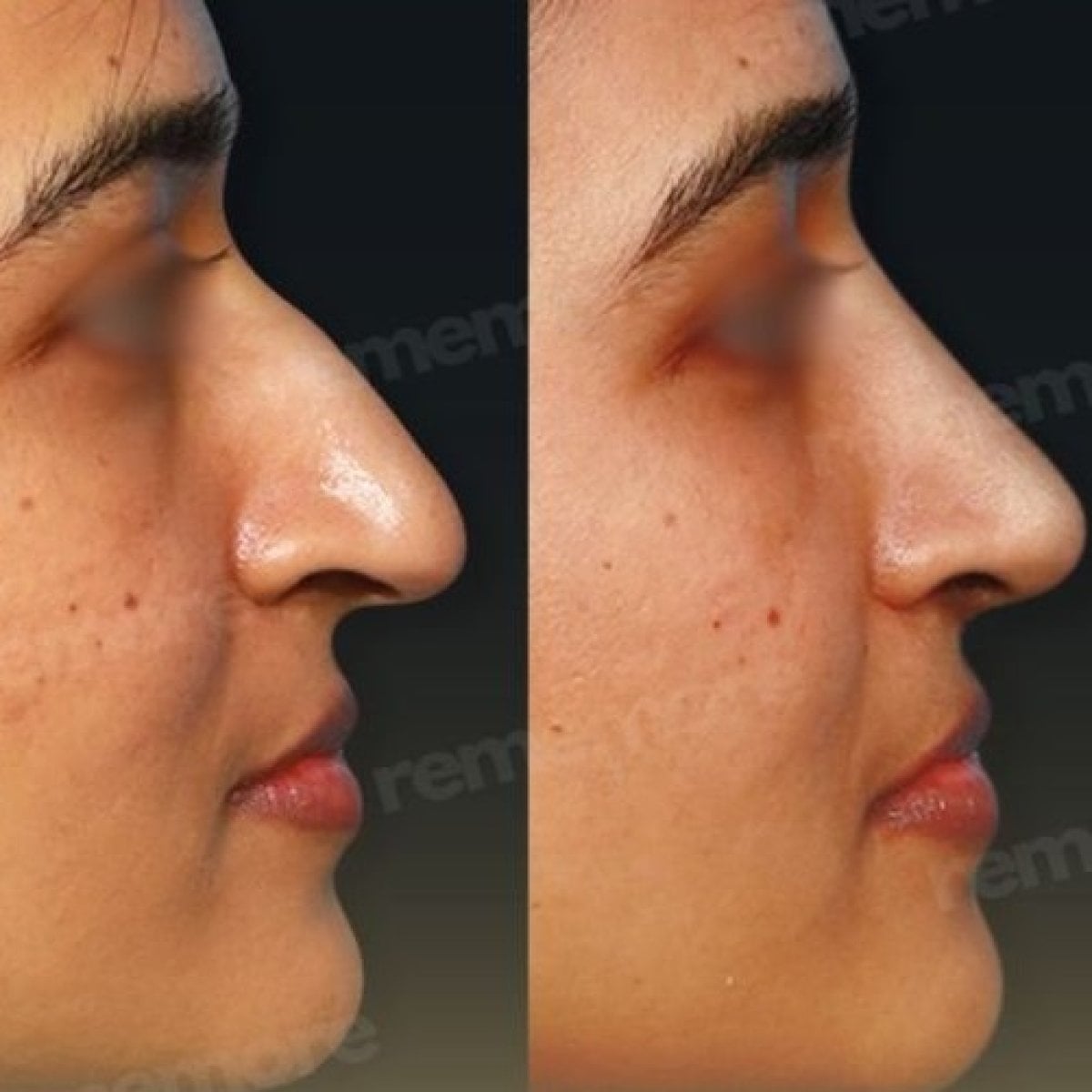 نتائج قبل وبعد عملية تجميل الأنف في مستشفى ميموريال بهجيليفلر، شكل أنف محسّن