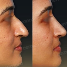 Before and after alarplasty results at Memorial Bahçelievler Hospital, refined nose shape