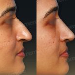 Before and after alarplasty results at Memorial Bahçelievler Hospital, refined nose shape