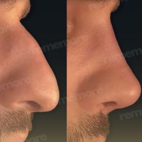 Before and after alarplasty results at Memorial Bahçelievler Hospital, refined nose shape