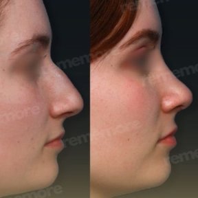 Before and after alarplasty results at Memorial Bahçelievler Hospital, refined nose shape