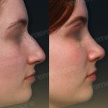 Before and after alarplasty results at Memorial Bahçelievler Hospital, refined nose shape