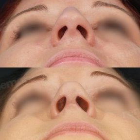 Before and after alarplasty results at Memorial Bahçelievler Hospital, nostril reshaping