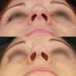 Before and after alarplasty results at Memorial Bahçelievler Hospital, nostril reshaping